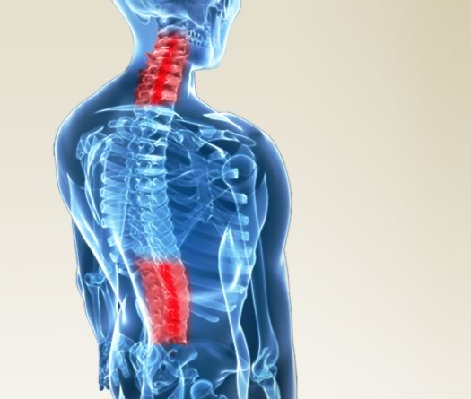 Spinal Stenosis Image